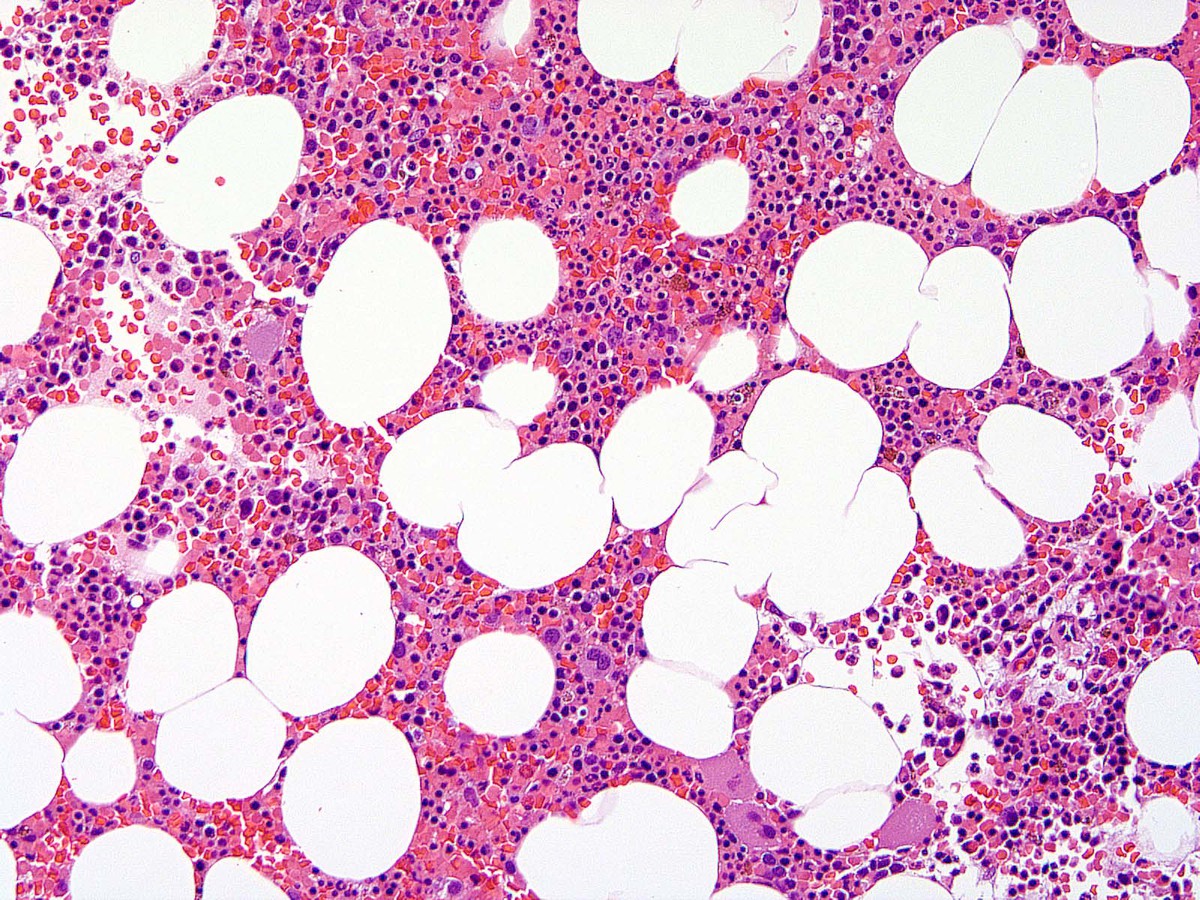 Figure 4. Bone marrow biopsy showed normocellular marrow with trilineal hematopoiesis.